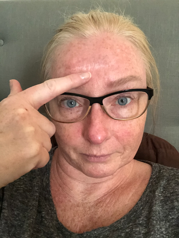 Blog #1 - Skin Cancer